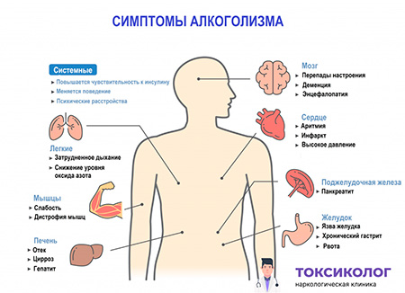 Симптомы алкоголизма 